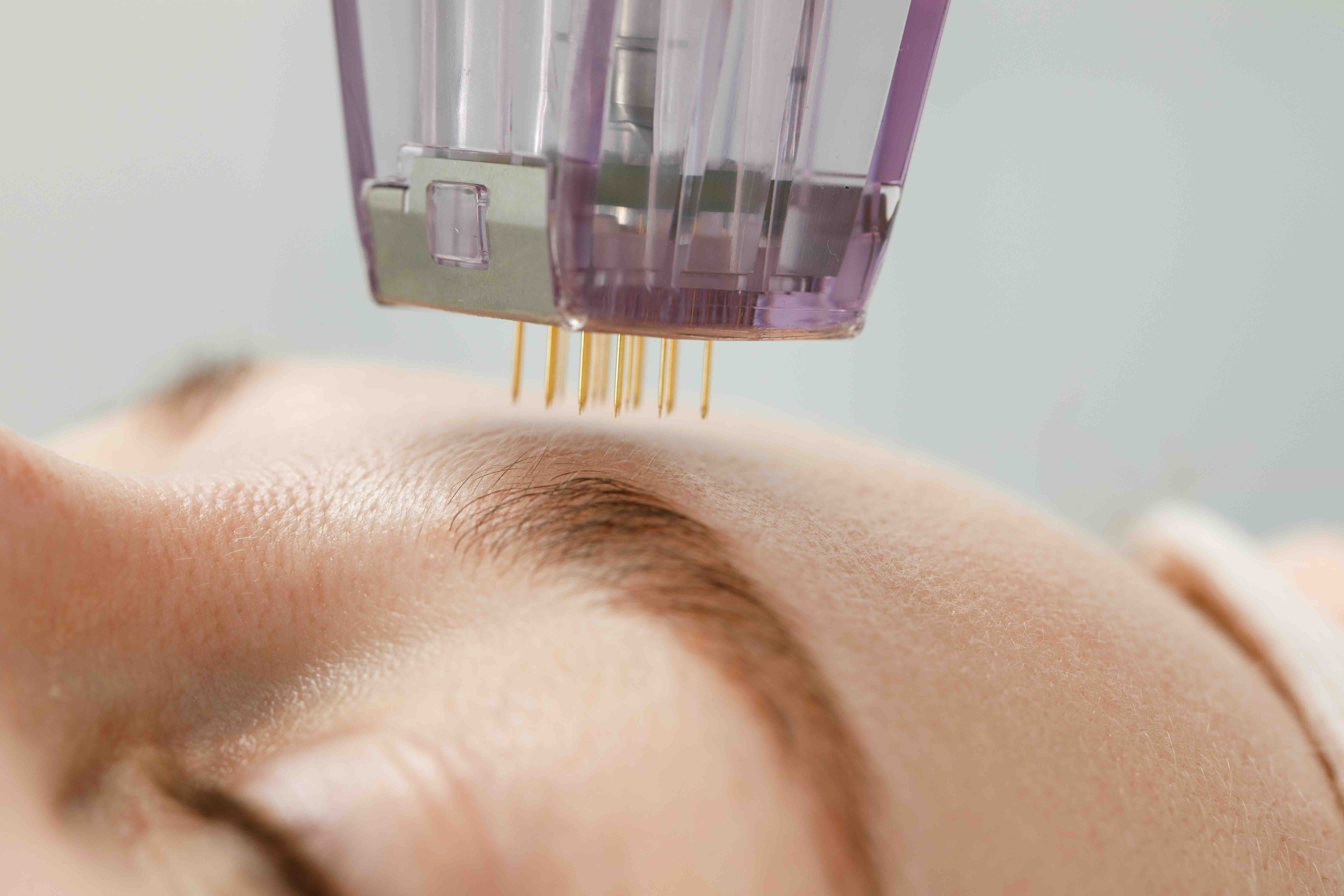 The secret of K-beauty: Revitalize your skin with skin boosters!