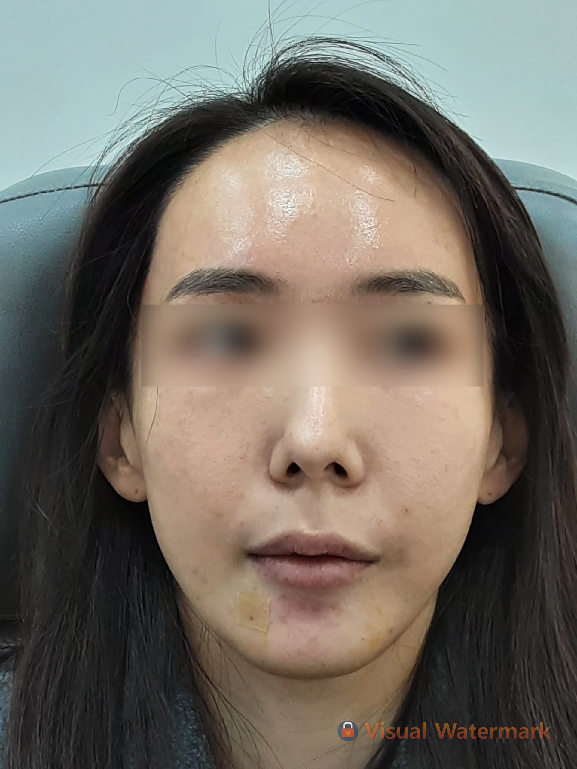 Beauty Stone Clinic — Case #1 — After