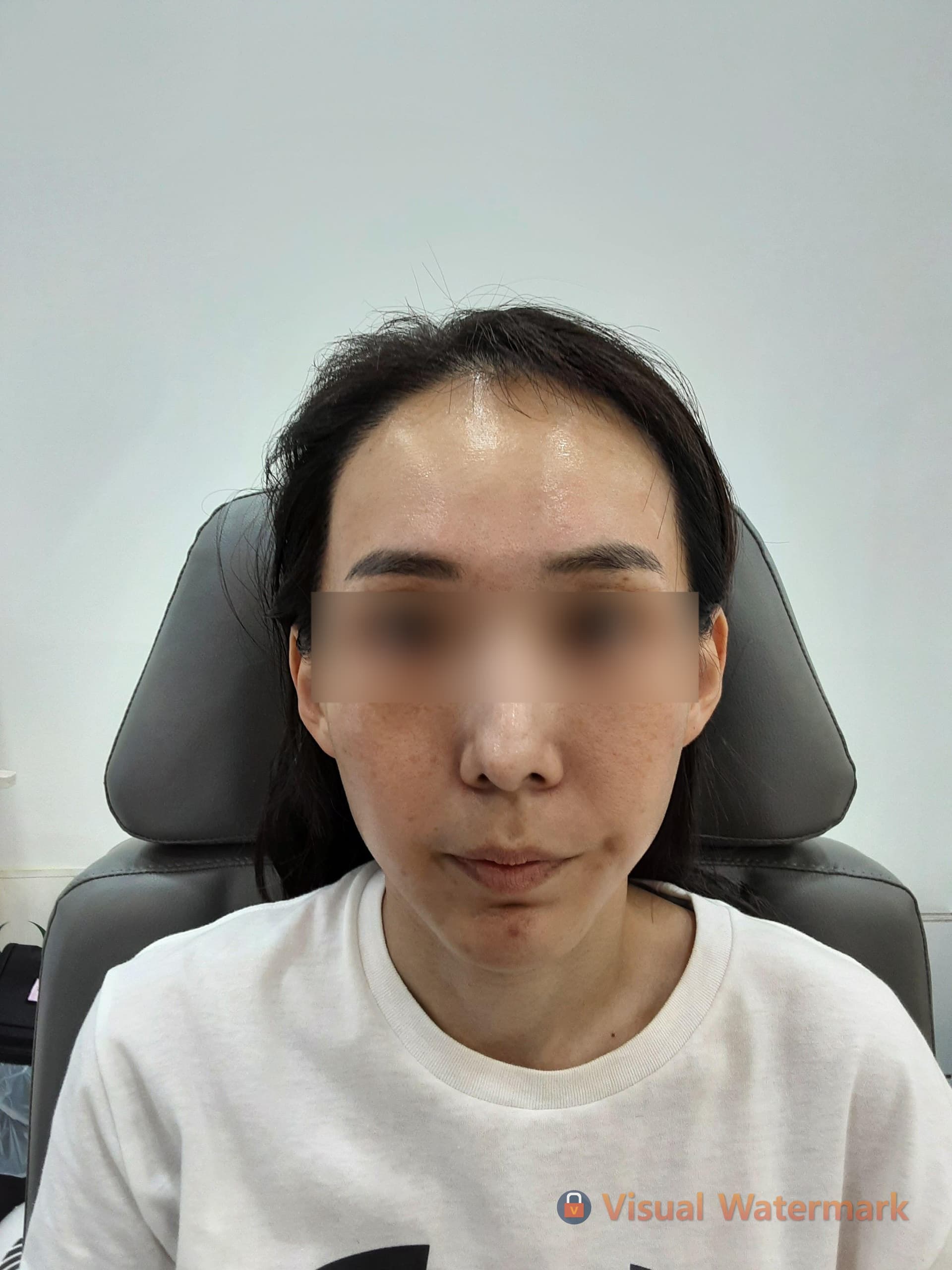Beauty Stone Clinic — Case #1 — Before