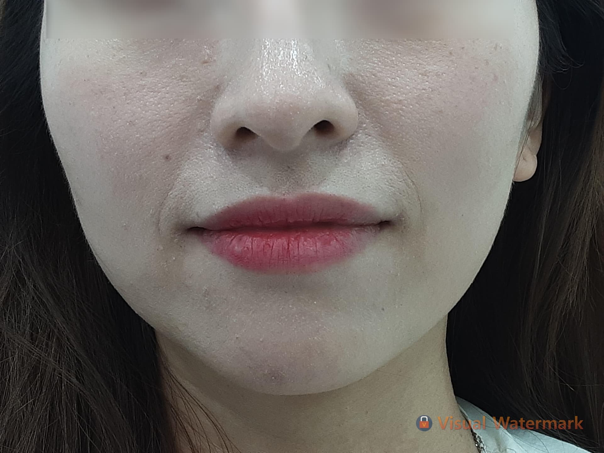 Beauty Stone Clinic — Case #4 — Before