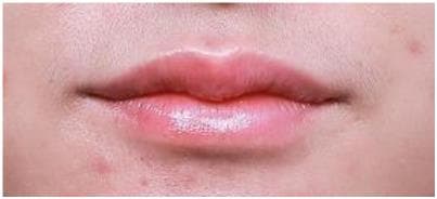 LIV Plastic Surgery — Case #15 — After