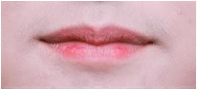 LIV Plastic Surgery — Case #15 — Before