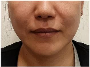 LIV Plastic Surgery — Case #8 — After