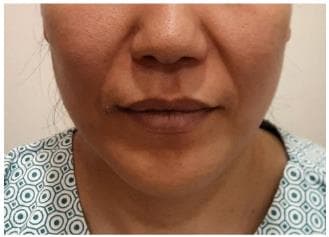 LIV Plastic Surgery — Case #8 — Before