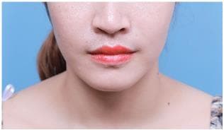 LIV Plastic Surgery — Case #22 — After