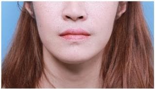 LIV Plastic Surgery — Case #22 — Before