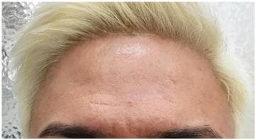 LIV Plastic Surgery — Case #10 — After