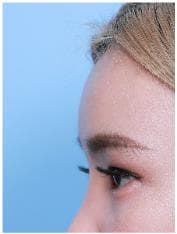 LIV Plastic Surgery — Case #7 — After
