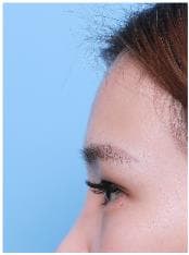 LIV Plastic Surgery — Case #7 — Before