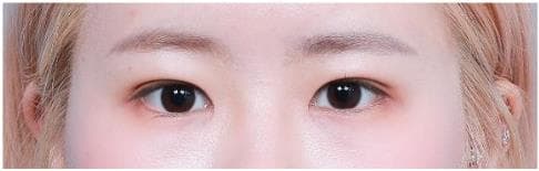 LIV Plastic Surgery — Case #5 — After