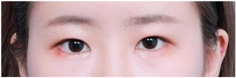 LIV Plastic Surgery — Case #5 — Before