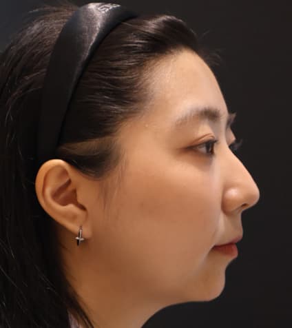 LIV Plastic Surgery — Case #12 — After