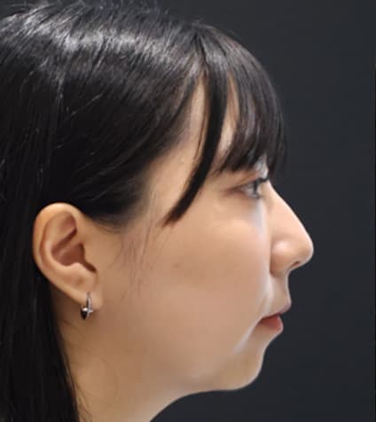 LIV Plastic Surgery — Case #12 — Before