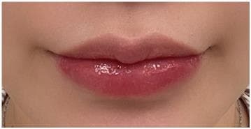 LIV Plastic Surgery — Case #1 — After