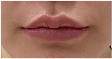 LIV Plastic Surgery — Case #1 — Before