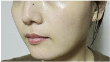 LIV Plastic Surgery — Case #11 — After