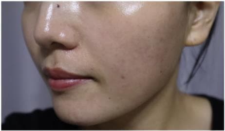 LIV Plastic Surgery — Case #11 — Before