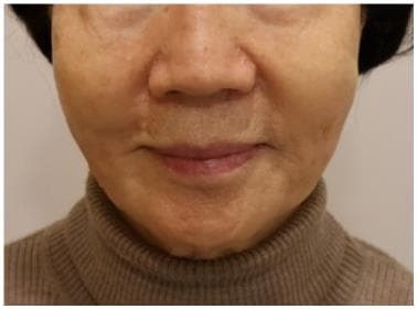 LIV Plastic Surgery — Case #18 — After