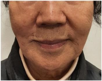 LIV Plastic Surgery — Case #18 — Before