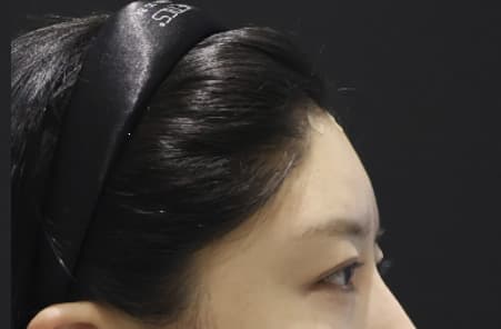 LIV Plastic Surgery — Case #6 — After
