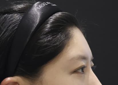 LIV Plastic Surgery — Case #6 — Before