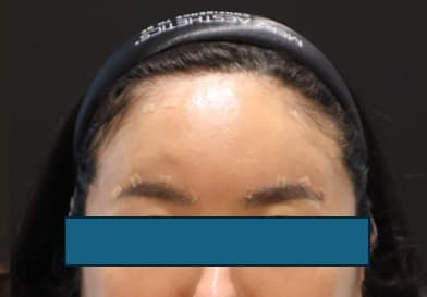LIV Plastic Surgery — Case #19 — After