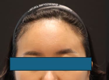 LIV Plastic Surgery — Case #19 — Before