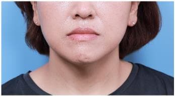 LIV Plastic Surgery — Case #4 — After