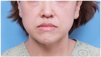 LIV Plastic Surgery — Case #4 — Before