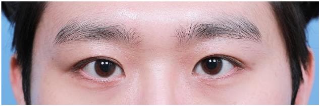 LIV Plastic Surgery — Case #2 — After