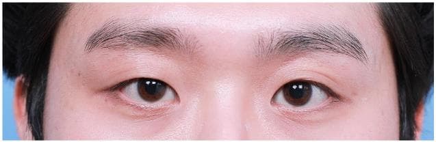 LIV Plastic Surgery — Case #2 — Before