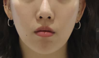 LIV Plastic Surgery — Case #9 — Before