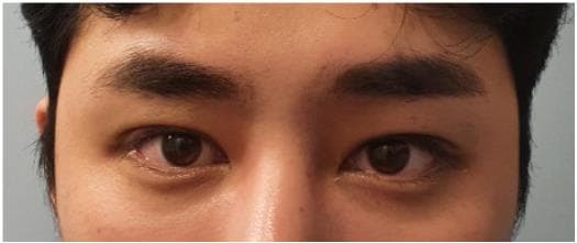 LIV Plastic Surgery — Case #14 — After