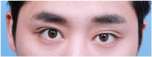 LIV Plastic Surgery — Case #14 — Before