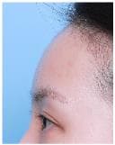 LIV Plastic Surgery — Case #16 — After