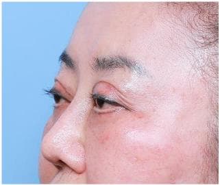 LIV Plastic Surgery — Case #3 — After