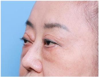 LIV Plastic Surgery — Case #3 — Before