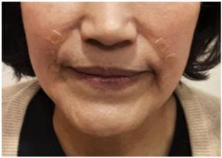 LIV Plastic Surgery — Case #21 — After