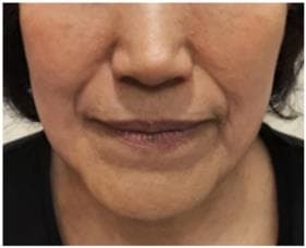 LIV Plastic Surgery — Case #21 — Before