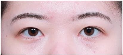 LIV Plastic Surgery — Case #13 — After