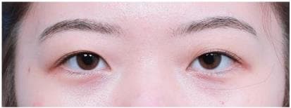LIV Plastic Surgery — Case #13 — Before